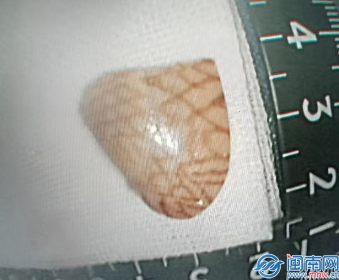 好险！米粉汤吃太快，五旬阿姨花蛤壳卡食道