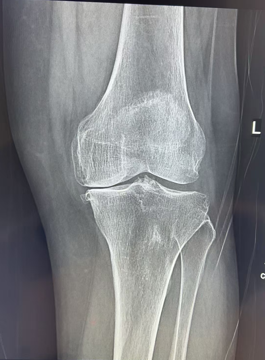 告别“换膝”恐惧！漳州第三医院：中老年膝痛可选保膝治疗