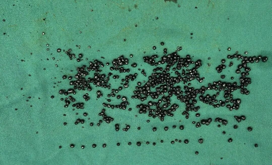 漳州第三医院成功实施微创胆囊切除术 取出近300颗结石