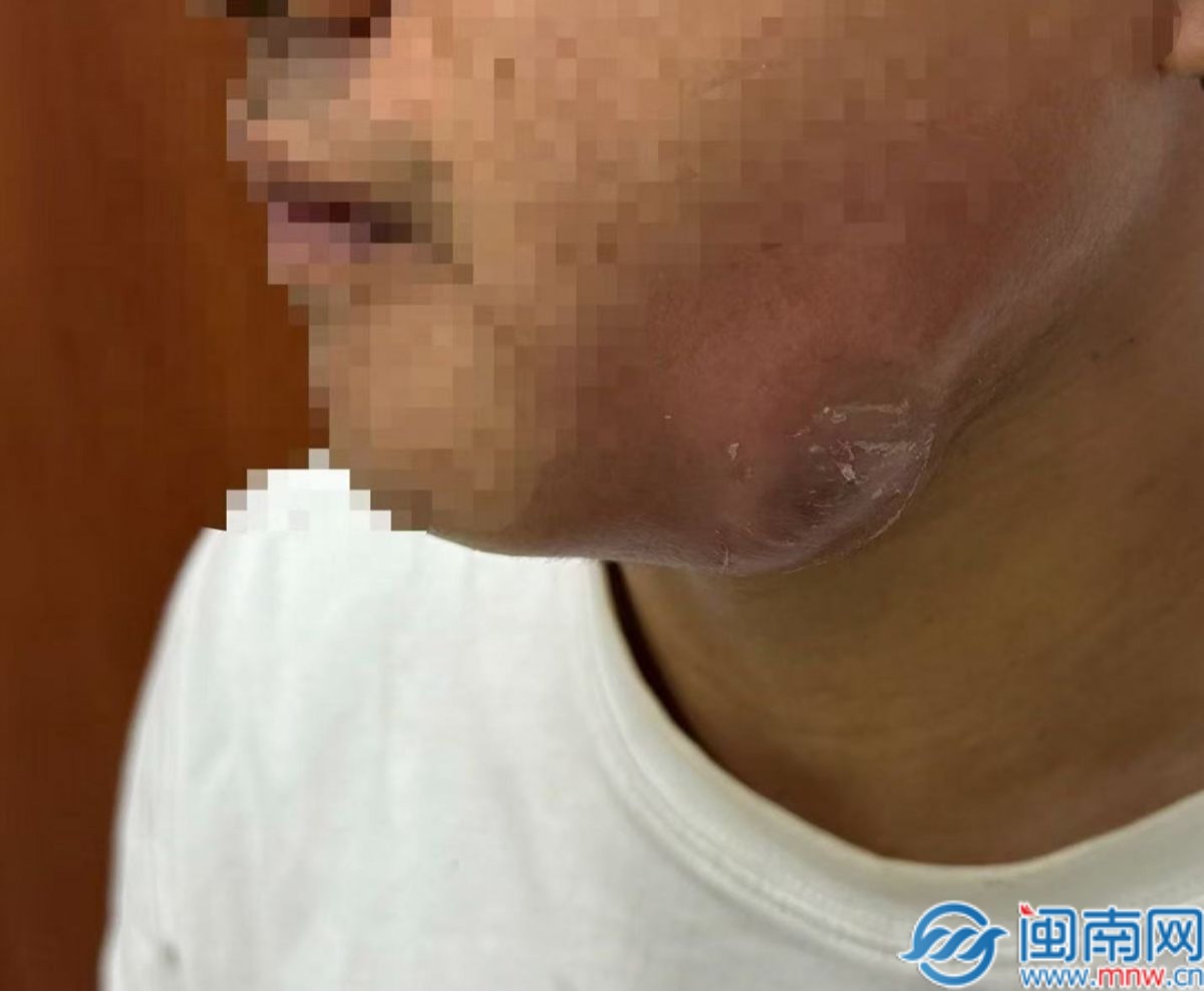 泉州一男子智齿反复发炎 下颚憋出“桃子小脓包”！