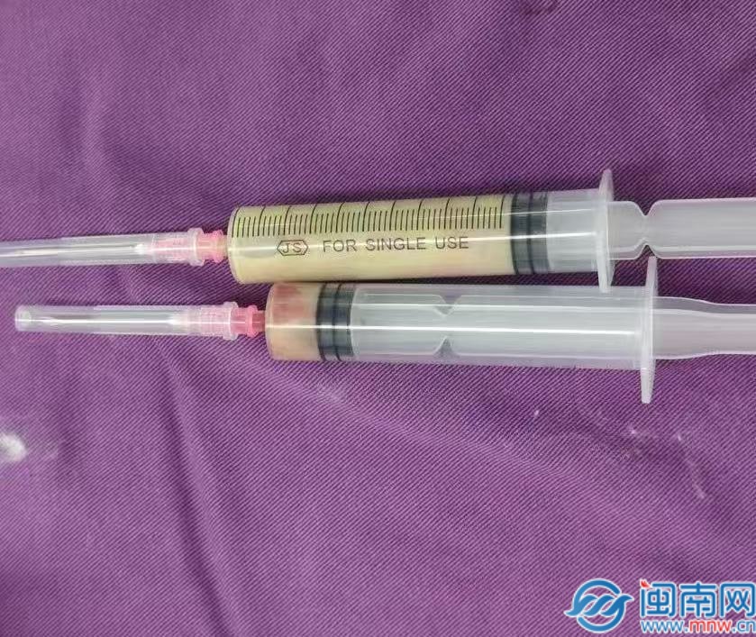 泉州：小感冒拖成脑脓肿！医生从男子颅内抽出12ml乳白脓液！