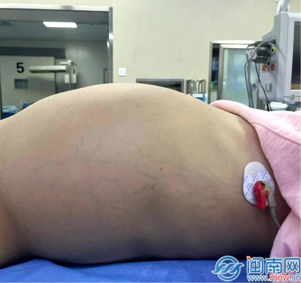 泉州一个10岁小女孩，肚子鼓鼓的，竟是长了一个直径37厘米的大肿瘤