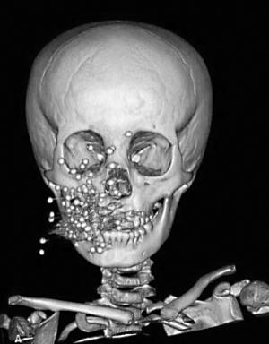 安徽一男孩模仿《猫和老鼠》玩枪 炸入脸部86颗钢珠(图)