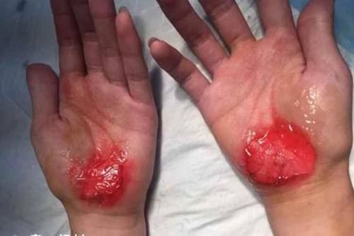 曝深圳西乡中学学生被体罚用手走路 双手磨破(现场图)