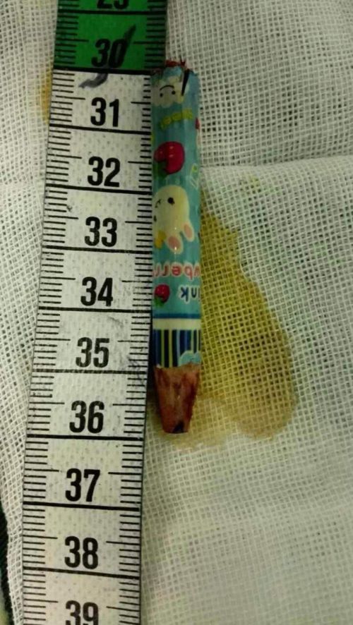 半截铅笔插入女童颅内长达1周 大坪医院1小时取出