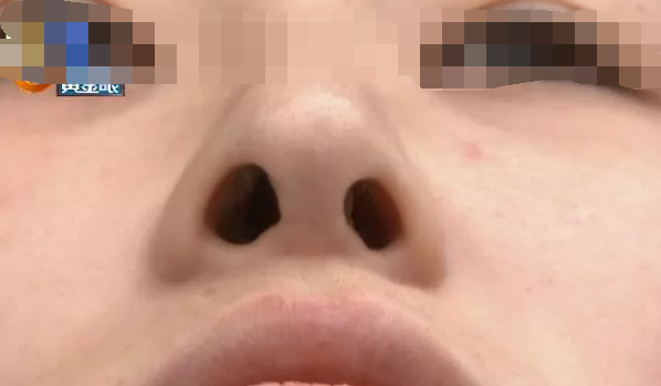 杭州千晴整形医院隆鼻后耳后根长了个包鼻孔也一大一小